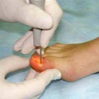 Цена на лечение вросшего ногтя лазером